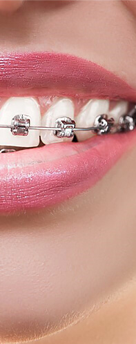 Braces sapphire